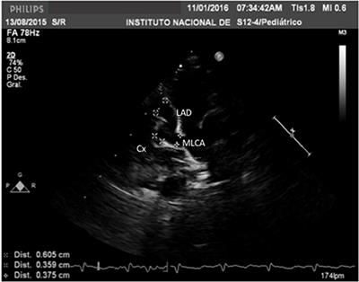 Kawasaki Disease in Infants in the First 3 Months of Age in a Mexican Population: A Cautionary Tale